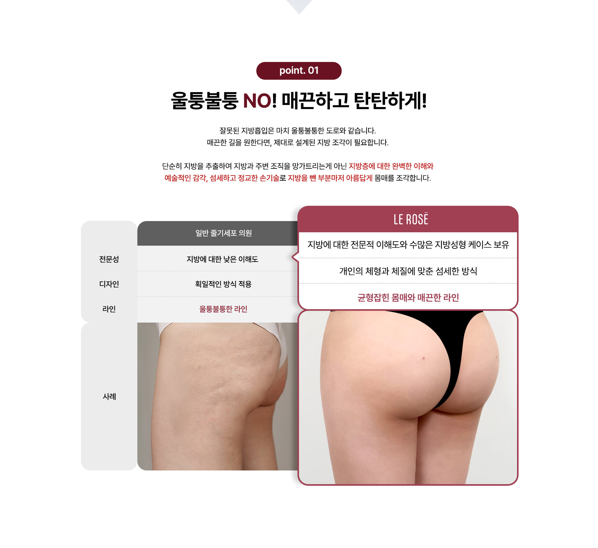 줄기세포 지방이식