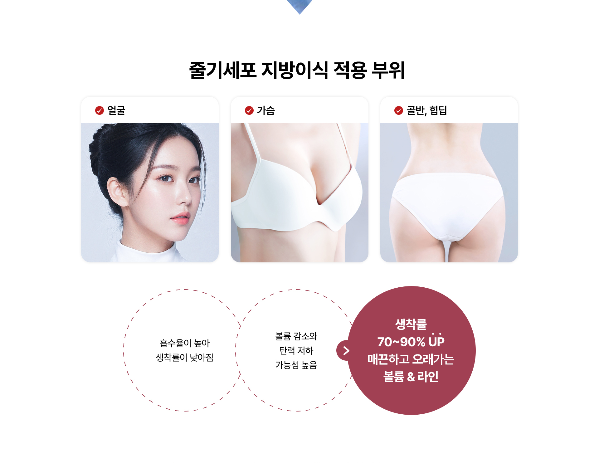줄기세포 지방이식